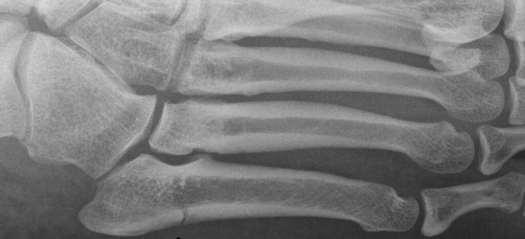 Kuvassa näkyy Jonesin murtumalinja viidennessä jalkapöydän luussa ns. metatarsaali V -luussa. 